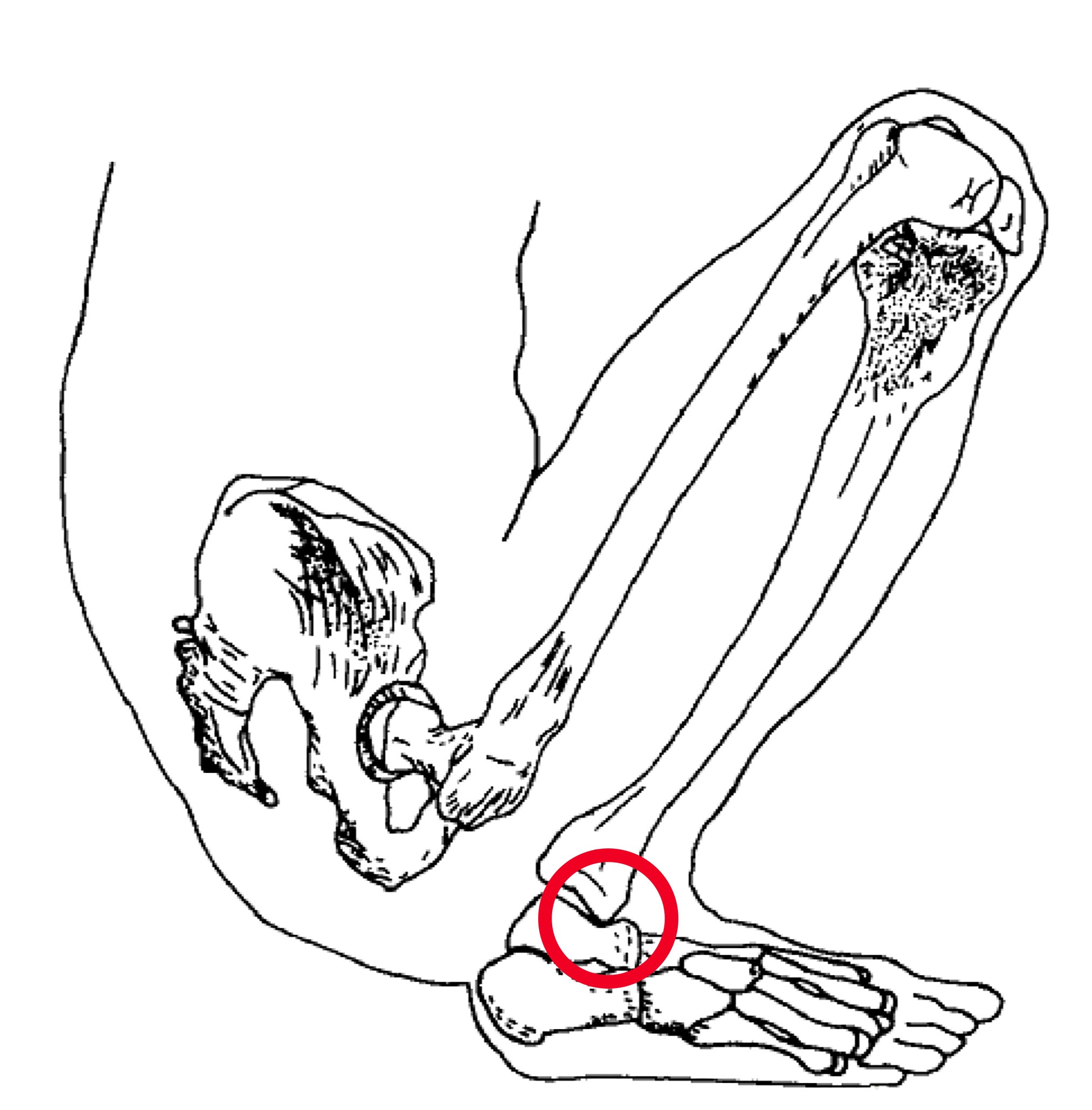 Squatting Position and Skeletal Consequences of Habitual Squatting (modified from Trinkaus 1975).