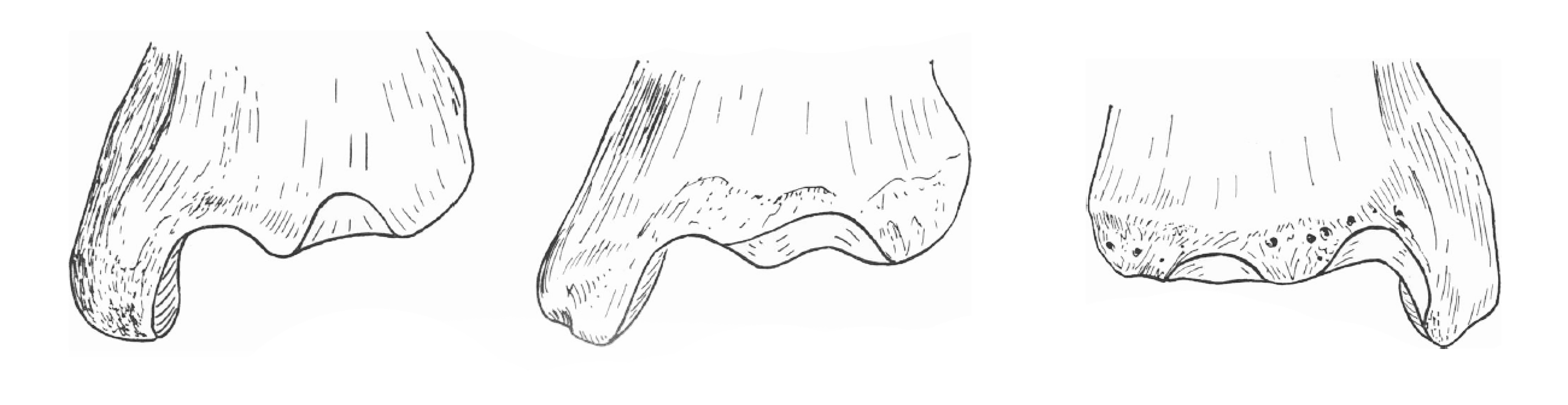 Images of Different Types of Squatting Facets on Distal Tibiae (modified from Singh 1959).